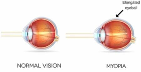 Myopia.jpg